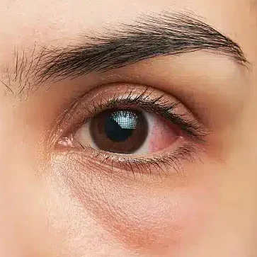 Everything You Need to Know About Conjunctivitis (Pink Eye)